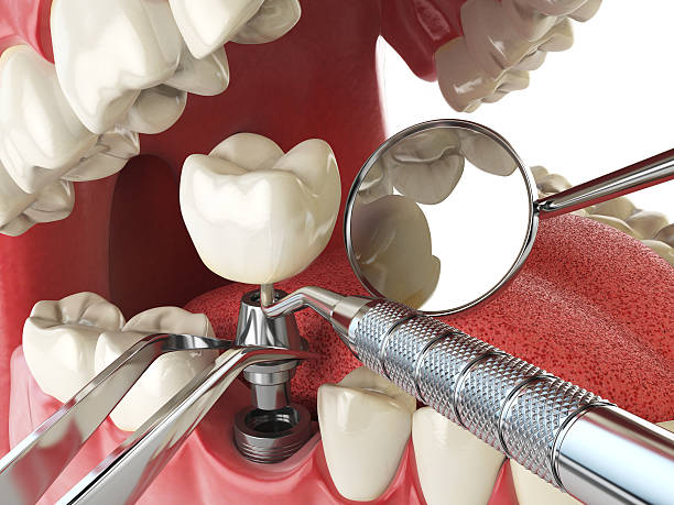 Best Emergency Treatment for Toothache in Chapin, SC